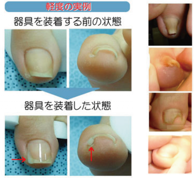 巻き爪補正の様子